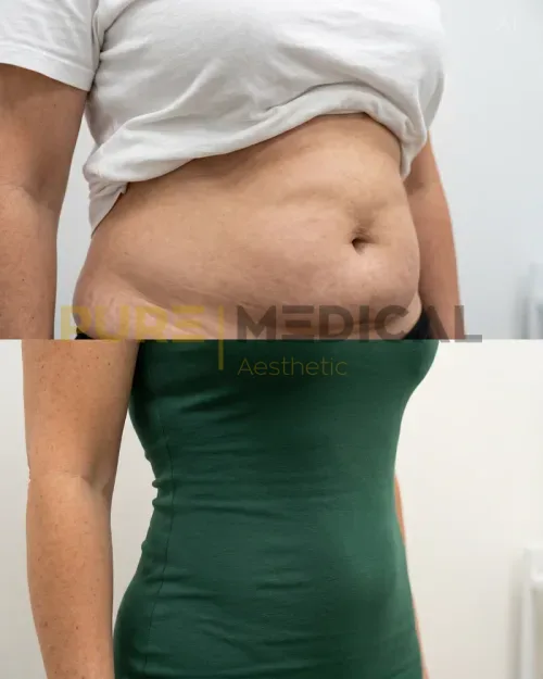 Vorher Nachher Bauch, Fett-Weg-Behandlung
