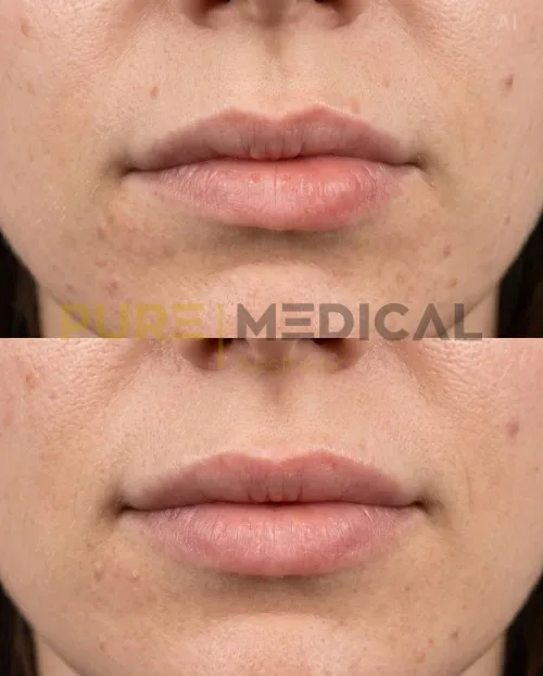 Vorher Nachher Asymmetrie, Lippenvergrößerung