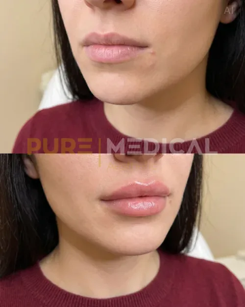 Vorher Nachher Volumenlippe, Lippenvergrößerung
