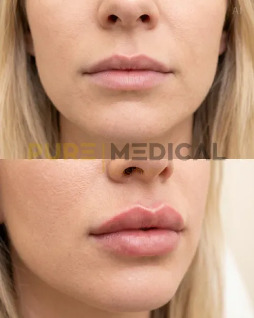 Vorher Nachher Russian Lips, Lippenvergrößerung