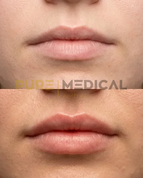 Vorher Nachher Volumenlippe, Lippenvergrößerung